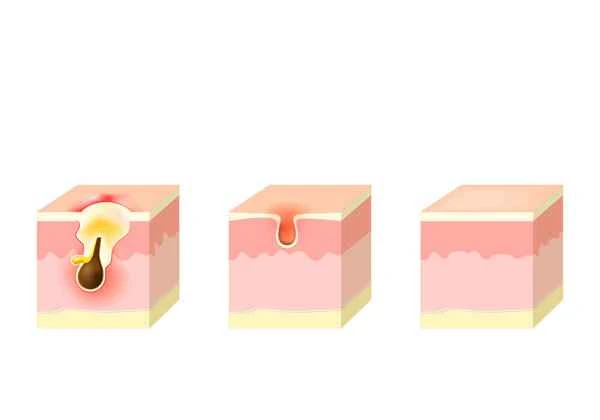 What ointment should I use for seborrheic dermatitis?