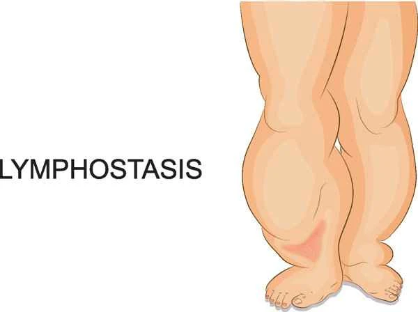 How to exercise muscles if you have keloid scarring