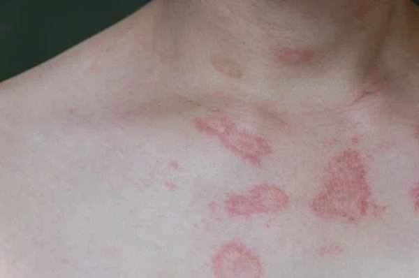 What could be causing my itchy red bumps all over my body?