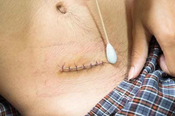 How long does the hyperplasia period of a mole removal scar last?