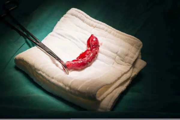 What to do about scar contracture of the posterior pharyngeal wall?