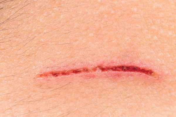 How to remove residual skin scars
