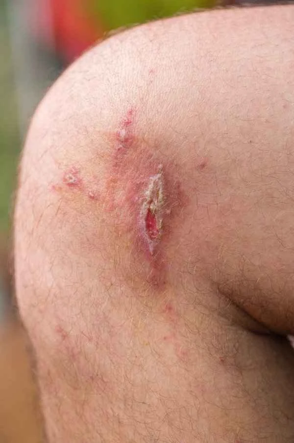How long does it take for a scar to grow into a large, painful lump?