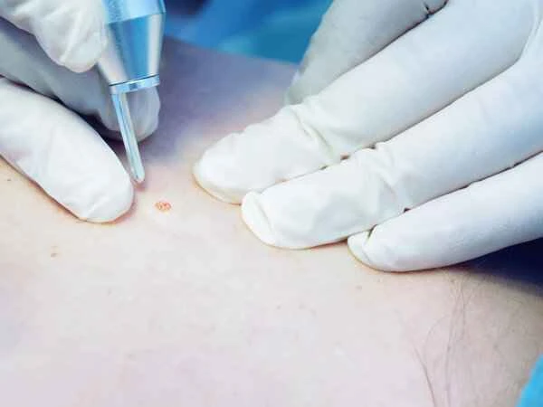 How to remove tattoos on scars