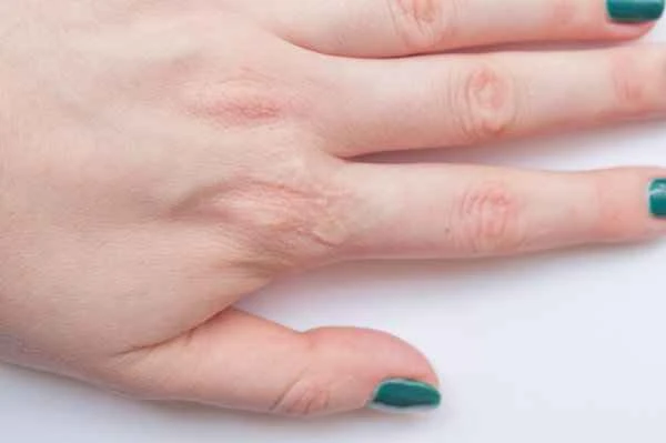 How to remove frostbite scars