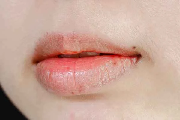 Is dry, chapped lips in winter a sign of cheilitis?