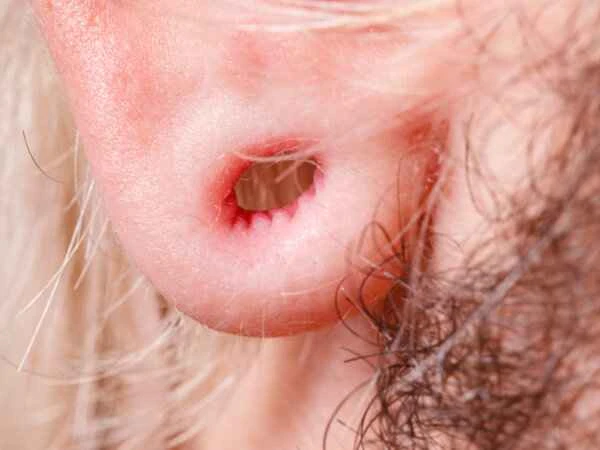 How long after keloid removal on the earlobe does it recur?