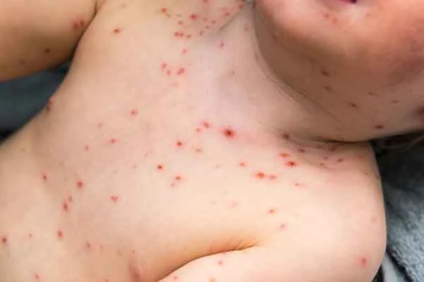 How can shingles be cured quickly?