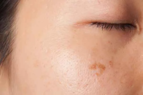 What disease causes yellowing of the skin?