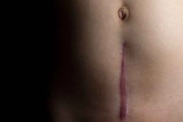 How is scar repair performed?