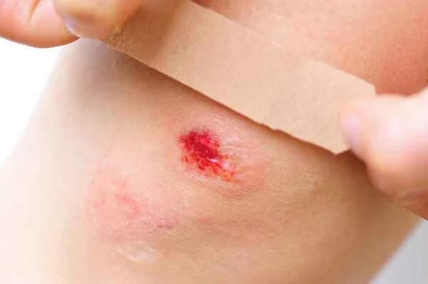 What exactly is a scar?