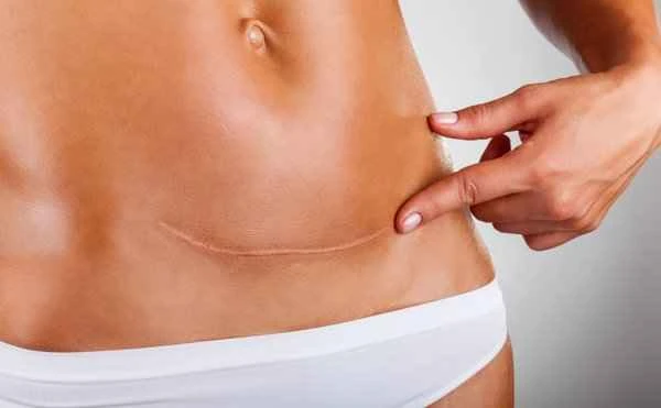 How to remove keloid scars around the anus