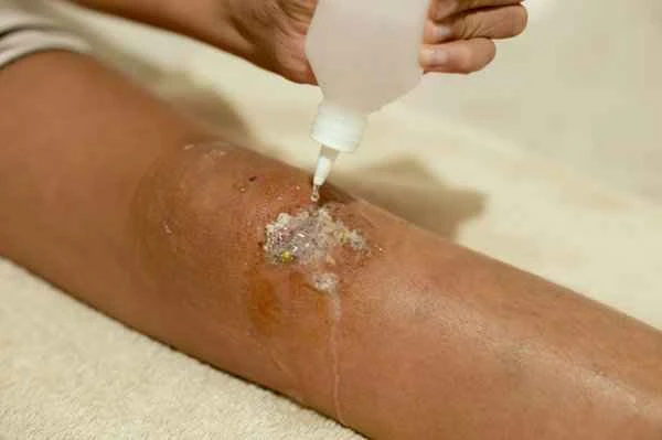 Can zinc oxide ointment be applied to the anus?