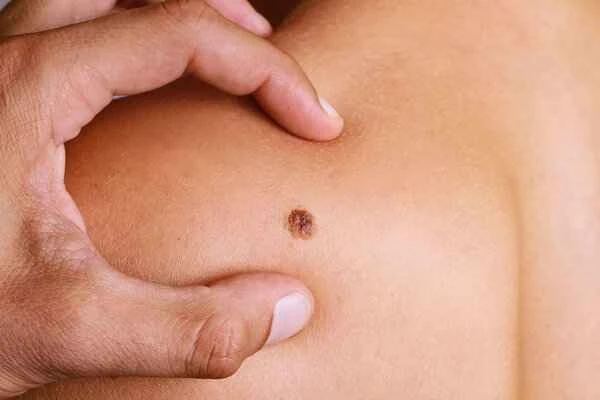How long does it take for a mole removed from a scarred skin to heal properly?