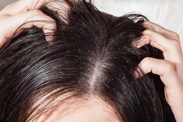 What happens if you shave your scalp for dandruff over a long period of time?