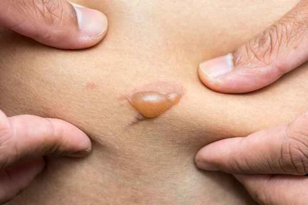 How to prevent scarring in people with keloid-prone skin?