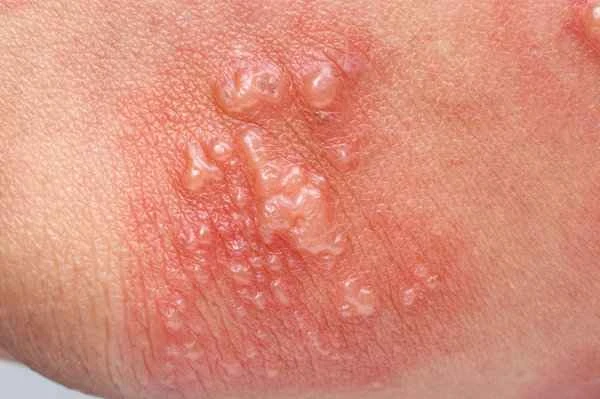 Does shingles require isolation?