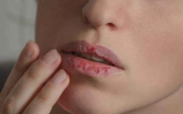 Is dry, chapped lips in winter a sign of cheilitis?