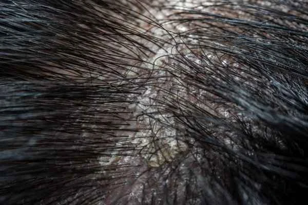 Perming caused scarring on the scalp