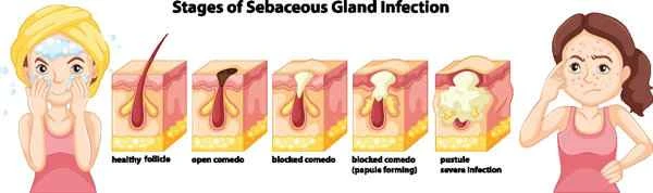 Can recurrent panniculitis be cured?