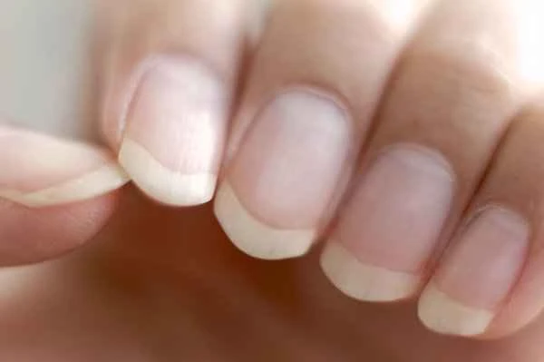 Do white spots on fingernails indicate roundworms?