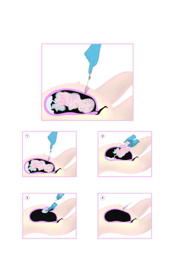 How to prevent hyperplasia of C-section scars
