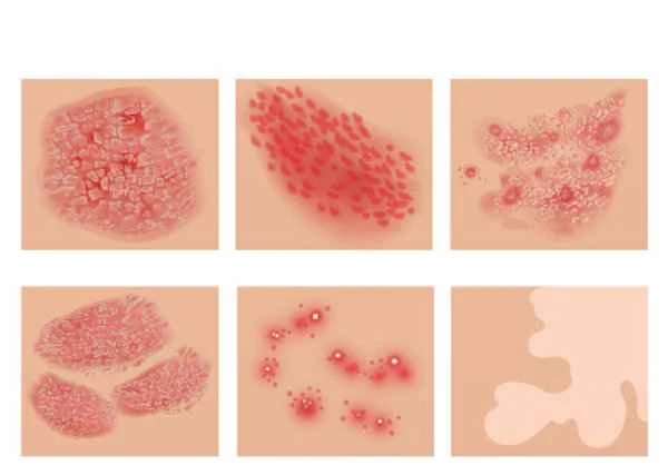 What are the causes of shingles rash?