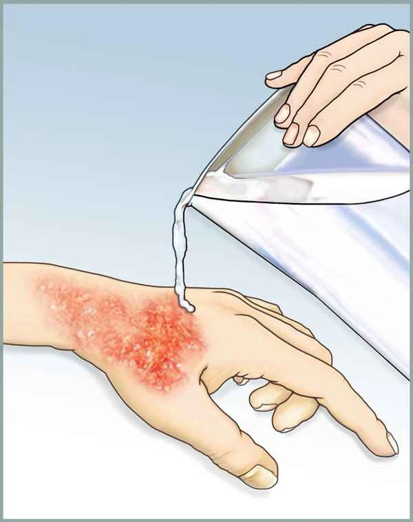 Can Bactroban soften scars?