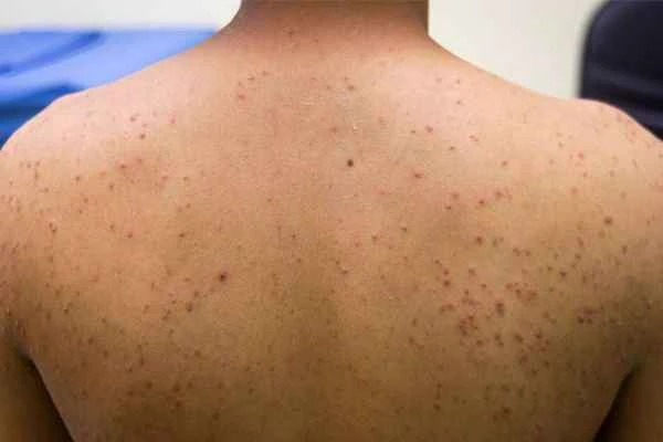 How to treat folliculitis with sinus tracts?