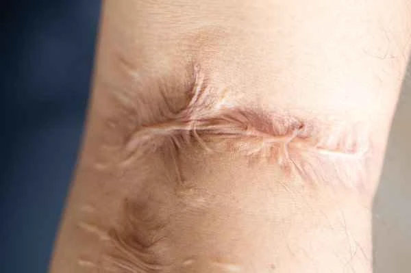 What is the best way to treat scars after amputation?