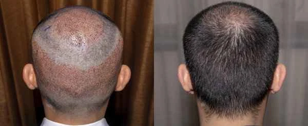 Folliculitis after hair transplant