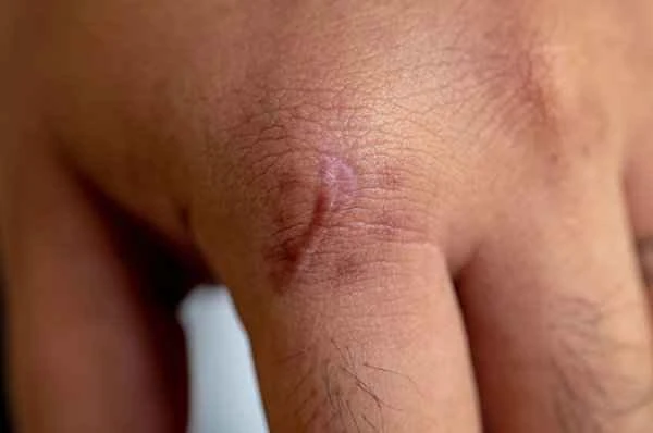 How to rehabilitate scar adhesions?