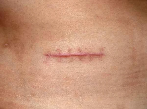 Keloids appear after skin lesion repair