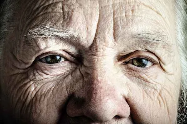 What disease causes yellowing of the skin?