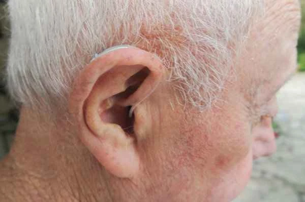 How to treat keloid scars on the auricle