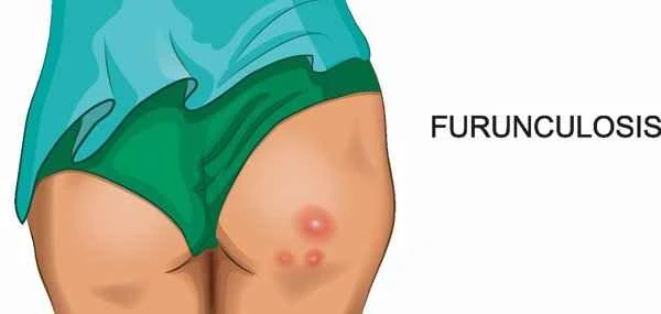 How to remove boil scars