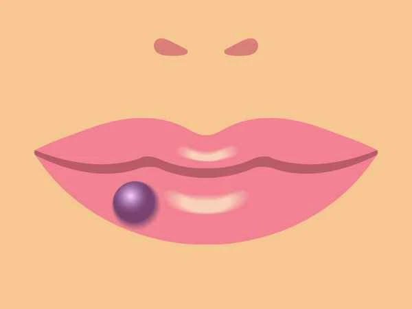 How to prevent scar hyperplasia with medication