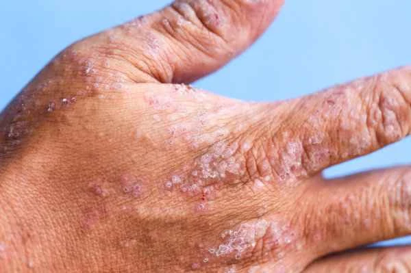 Can recurrent panniculitis be cured?