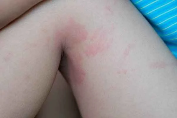 The harm of urticaria to people