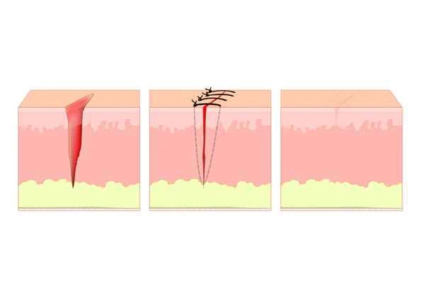 How to remove pigmentation from mole removal scars?