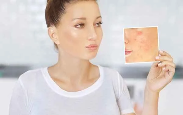 How to distinguish between acne scars and pimple marks?