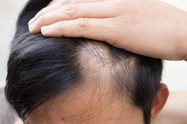 What deficiency can cause hair loss?