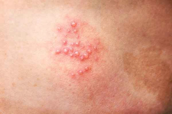 How to remove herpes scars?