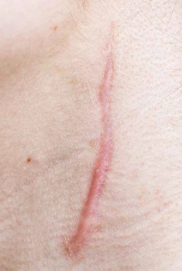 How to remove surgical scars