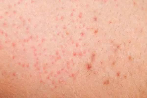 Folliculitis after hair transplant