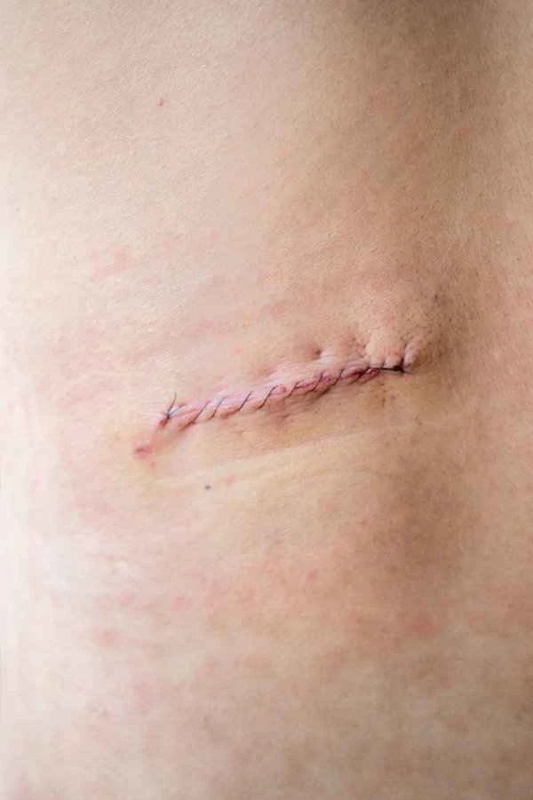 What to do about scar formation