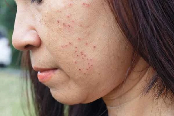 How to quickly reduce swelling of red and swollen pimples on the nose