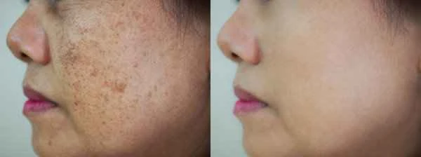 How long does it take for scar pigmentation to heal?