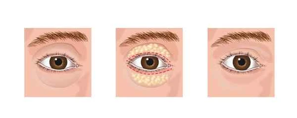 How to remove eye bags if you have keloid scarring
