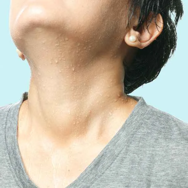 What causes frequent sweating on the head?